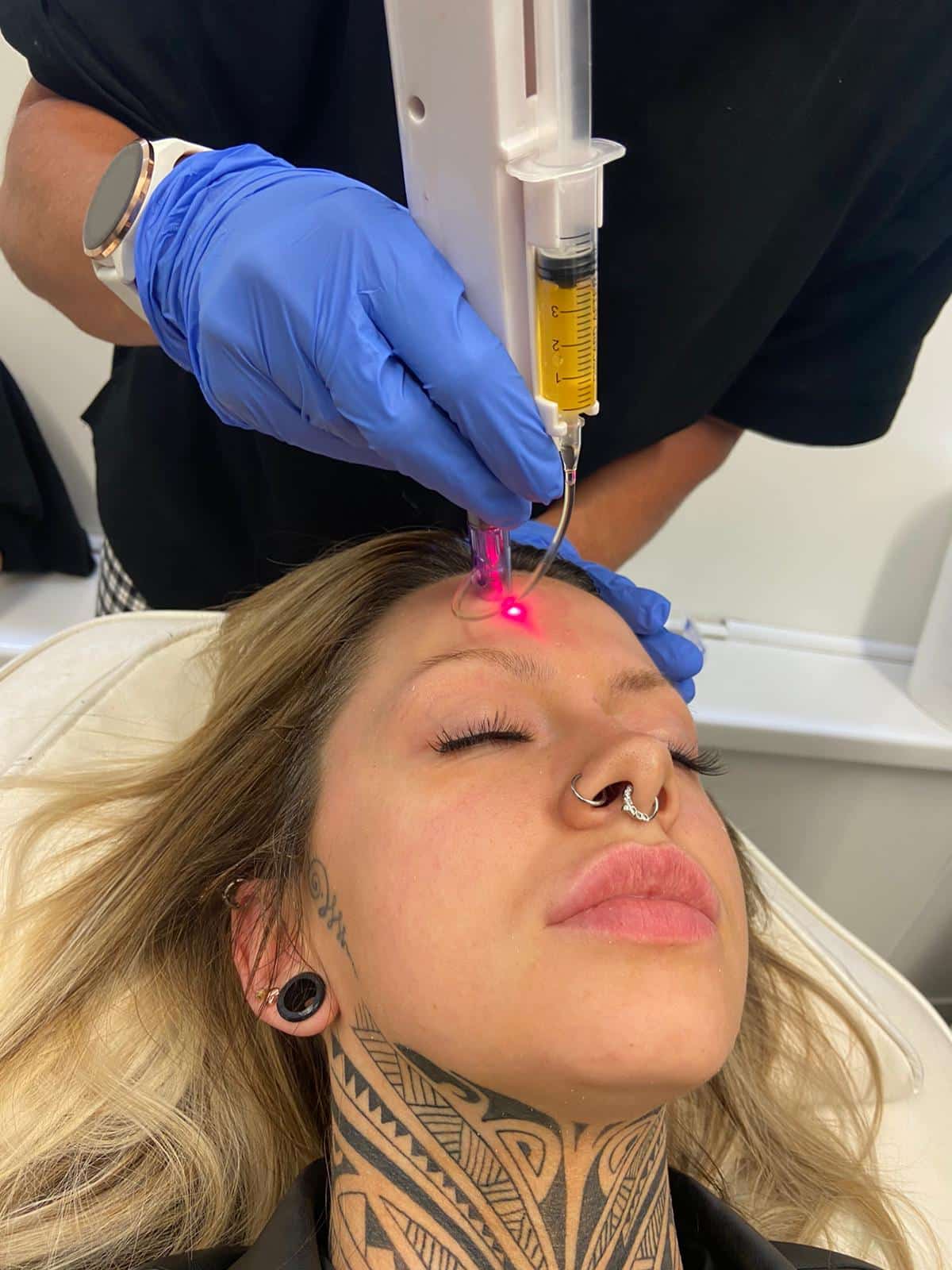 Microneedling Aesthetics